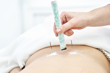 Woman being treated with acupuncture and moxibustion treatmentsの写真素材