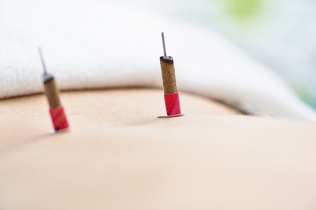 Woman being treated with acupuncture and moxibustion treatmentsの写真素材
