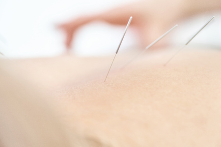 Alternative medicine. Close-up of female back with steel needles during procedure of acupuncture...