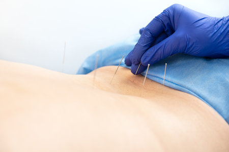 Close up of hand of doctor with blue latex gloves inserting acupuncture needle on back. medicine conceptの写真素材
