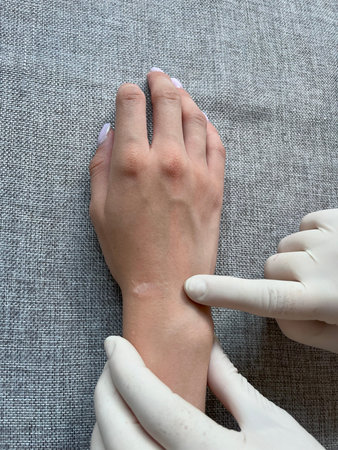 Doctor examines childs wrist with ganglion cyst. medical check focuses on hygroma and wrist neoplasm...
