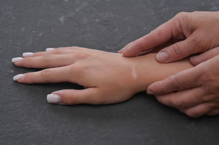 closeup of wrist with visible scar from recent ganglion cyst removal. Skin is healing with a slight swelling. Hand showing a surgical scar on wrist after ganglion cyst removal surgery. healing processの写真素材