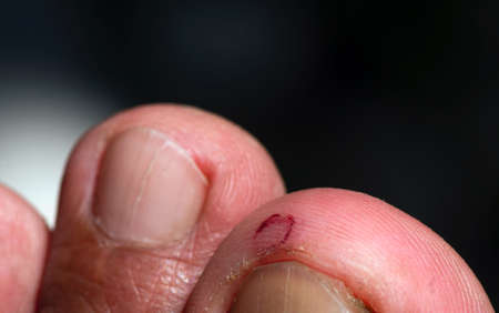 A wound on the big toe, dry skin and cracking skinの写真素材