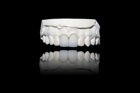 Zirconium crows with all porcelain