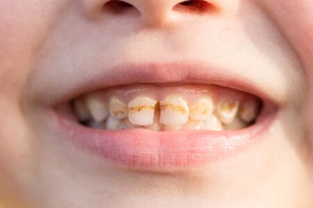 Close up child cariesの写真素材