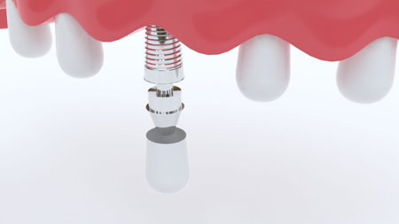 false tooth implant diagram