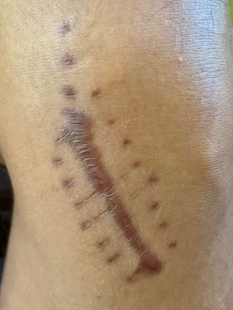 Scar on the leg from cutting wound. New normal skin with scar in the keloid area after injury. White and black skin.の写真素材