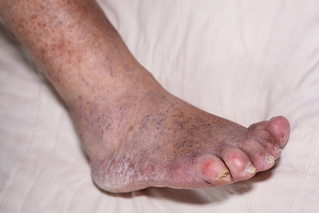 Detail of ill senior female swollen leg with damaged toes and nails.の写真素材