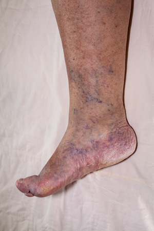 Detail of ill senior female swollen leg with damaged toes and nails.の写真素材