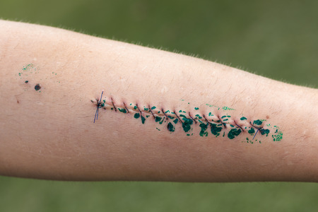 Closeup of wound and stitches on male forearm.の写真素材