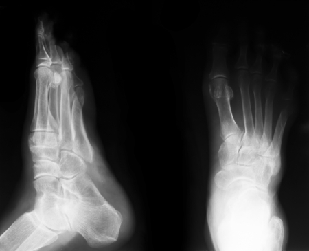 X-ray of both human feetの写真素材