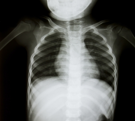 Chest x-ray of young boyの写真素材