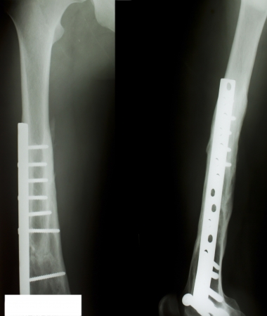 X-ray of both human legs (fractures).の写真素材