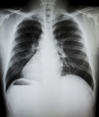 Chest x-ray of young boy.の写真素材