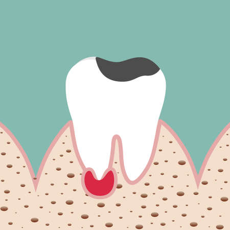 Dentist holding instruments and examining patient teeth. Teeth examination dentistry concept.Â のイラスト素材