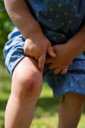 Little girl with abraded kneeの写真素材