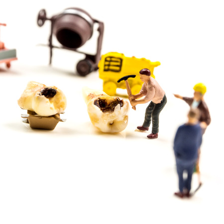 little miniature figurines workers fixing the problem with big caries on milk tooth molar by working on transportation of problematic tooth away on white backgroundの写真素材