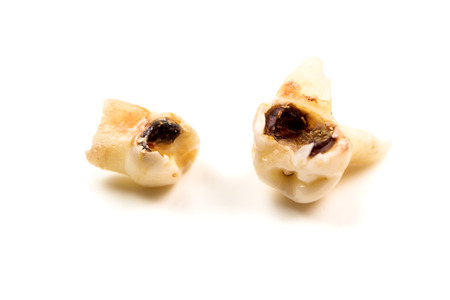 milk teeth molar with big caries on white backgroundの写真素材