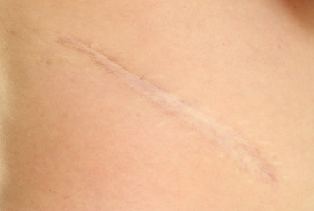 Cicatrice scar on forty years old man side after kidney surgery undergone in childhood