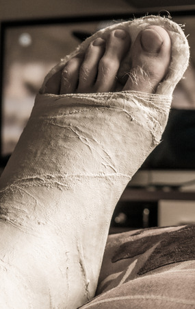 Broken legの写真素材