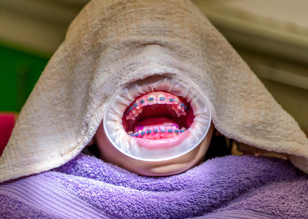 Young patient with dental braces and a cheek retractor in a clinic.
