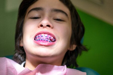 Young kid with colorful dental braces in dentistry. Plaque detection on teethの写真素材