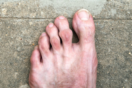Swollen joint on the toe. Rheumatoid arthritis.