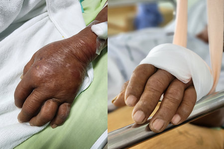 Patient hand is bandaged for postoperative infection treatment at hospital, self care concept.の写真素材