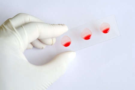 Blood group testing by slide methodの写真素材