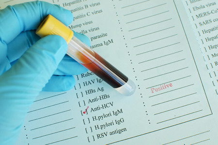 Hepatitis C virus positiveの写真素材