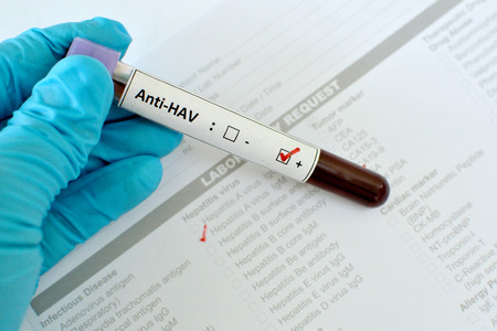 Hepatitis A positiveの写真素材