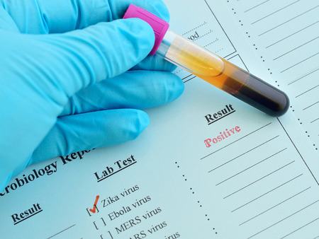 Zika virus positiveの写真素材