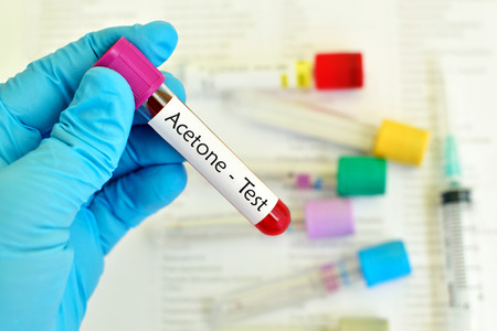Test tube with blood sample for acetone testの写真素材