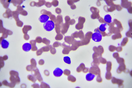 Leukemia cells in blood smear
