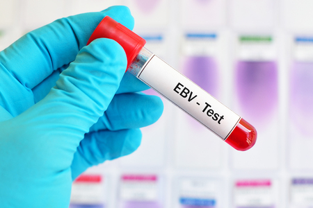 Blood sample for Epstein-Barr virus test Blood sample for Epstein-Barr virus test
