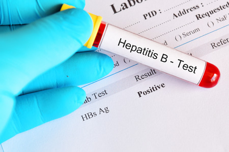 Hepatitis B virus positive test result with blood sample tubeの写真素材