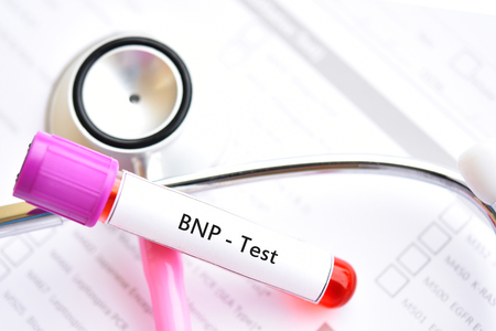 Blood sample for BNP testの写真素材