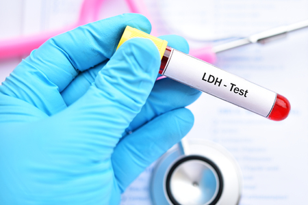 Blood sample tube for lactate dehydrogenase or LDH testの写真素材
