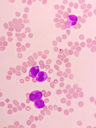 Acute promyelocytic leukemia cells or APLの写真素材