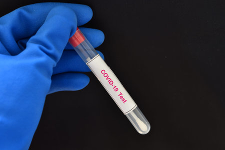 Nasopharyngeal swab from patient for COVID-19 test by using RT-PCR method
