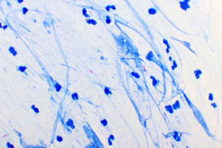 Mycobacterium tuberculosis positive (small red rod) in sputum smear, acid-fast stain, analyze by...