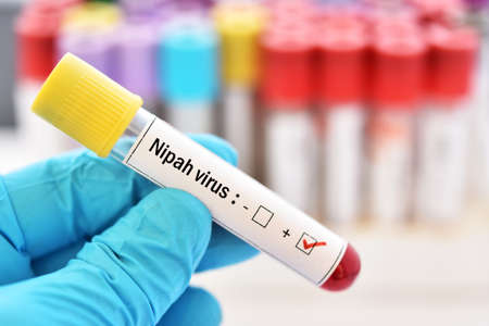 Blood sample tube positive with Nipah virus testの写真素材
