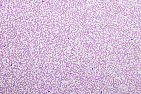 Red blood cells and white blood cells in blood smear, Wright-Giemsa stain, analyze by microscope, 10xの写真素材
