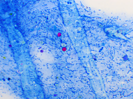 Cryptosporidium parvum protozoa positive (red sphere shape) in human stool smear, oocyst stage, acid-fast stain, analyze by microscope.の写真素材