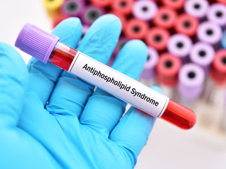 Blood sample tube for antiphospholipid syndrome (APS) test, diagnosis for autoimmune diseaseの写真素材