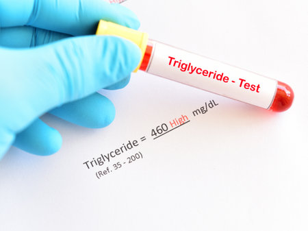 Blood sample with abnormal high triglyceride test resultの写真素材