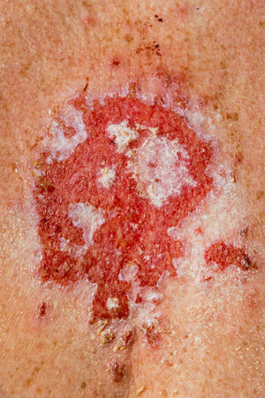 Superficial basal cell carcinoma reacting to imiquimod cream medication after consistent treatment showing red lesion on 30s caucasian female chest.の写真素材