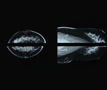 Mammography xray film image for breast cancerの写真素材
