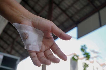 The hand is wounded, the wound is treated with a paste on the wound.の写真素材
