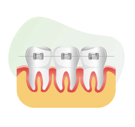 Set of Teeth with Dental Braces - stock illustration  as EPS 10 Fileのイラスト素材
